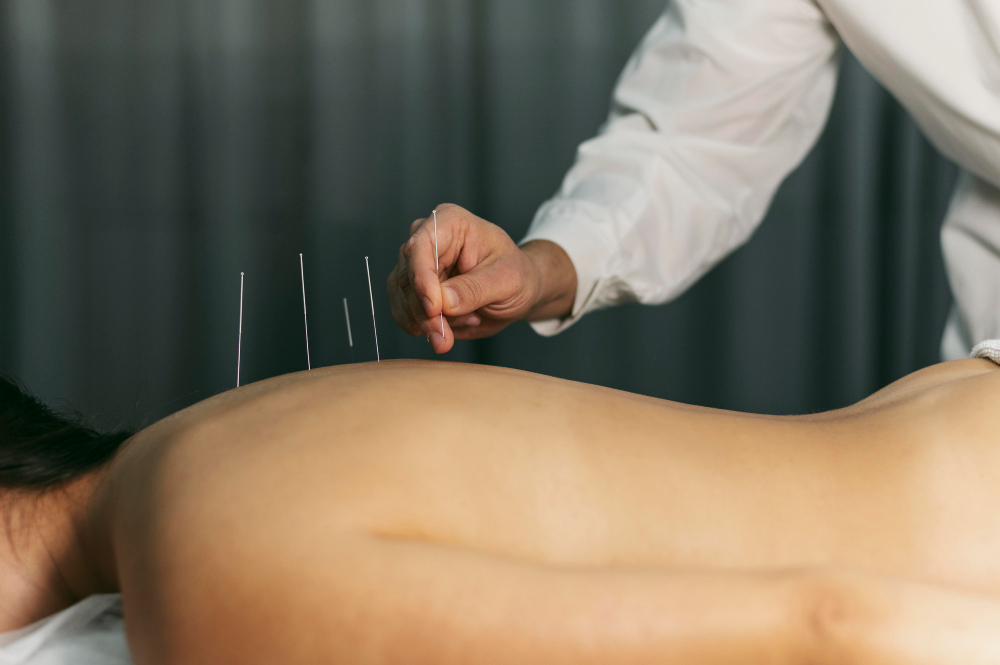 Acupuncture and Cupping